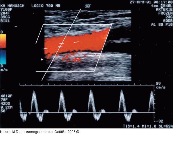 Duplexsonographie - Pulsdoppler