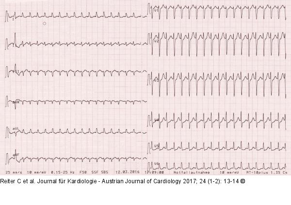 EKG - Aufnahme