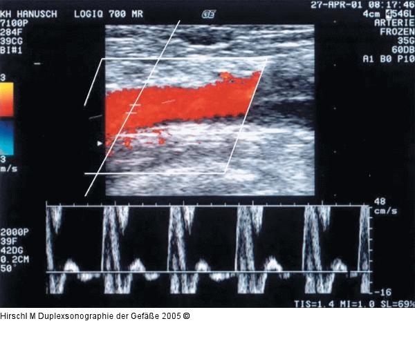 Duplexsonographie - Pulsdoppler
