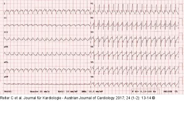 EKG - Adenosin 