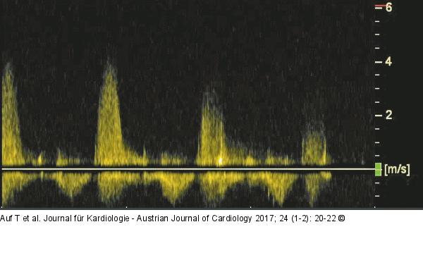 CW-Doppler-Signal