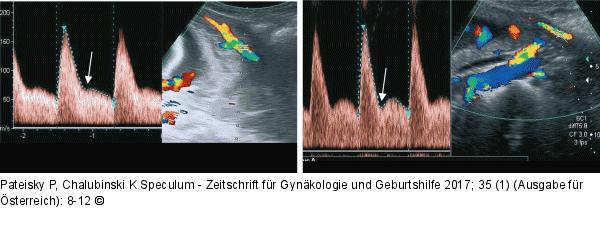 Dopplerkurve