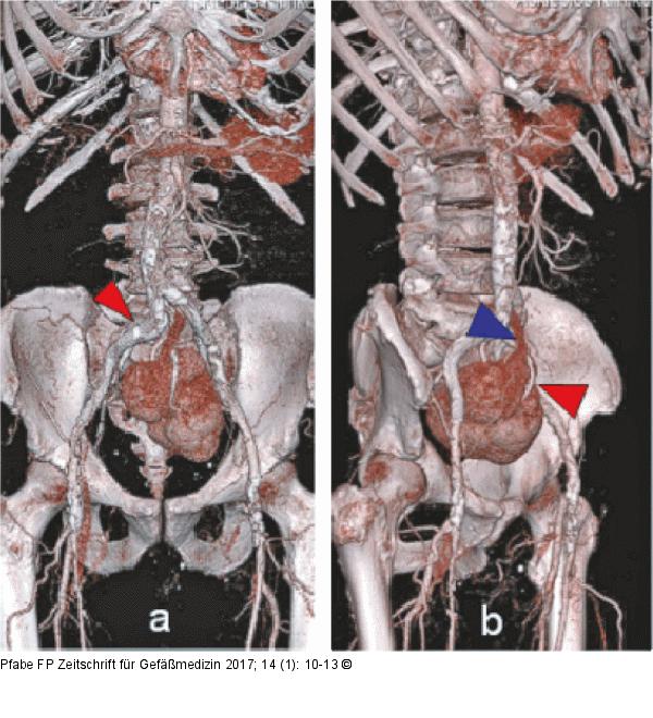 Thorax - Becken