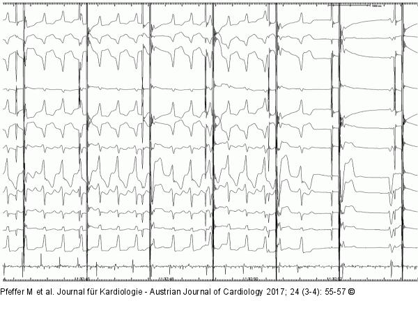 EKG