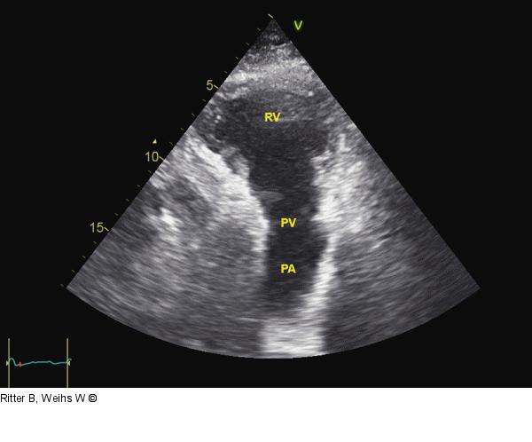 Pulmonalarterie