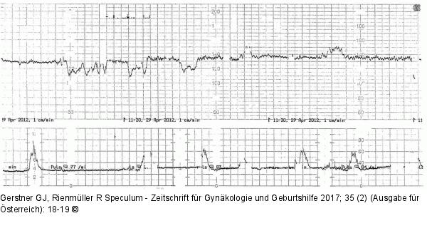 CTG pathologisch