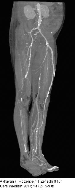 Venenbypass