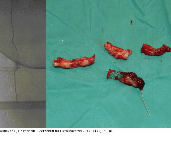 Stent