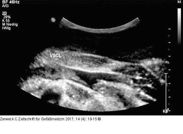 Thrombus - Vena subclavia