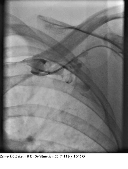 Präinterventionelle Angiographie