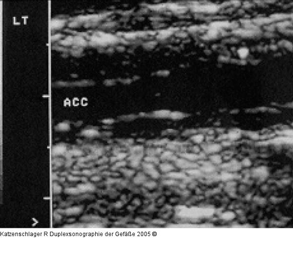 Duplexsonographie - Intima-Media