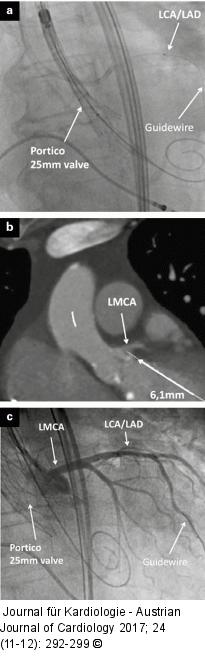 Valve implantation