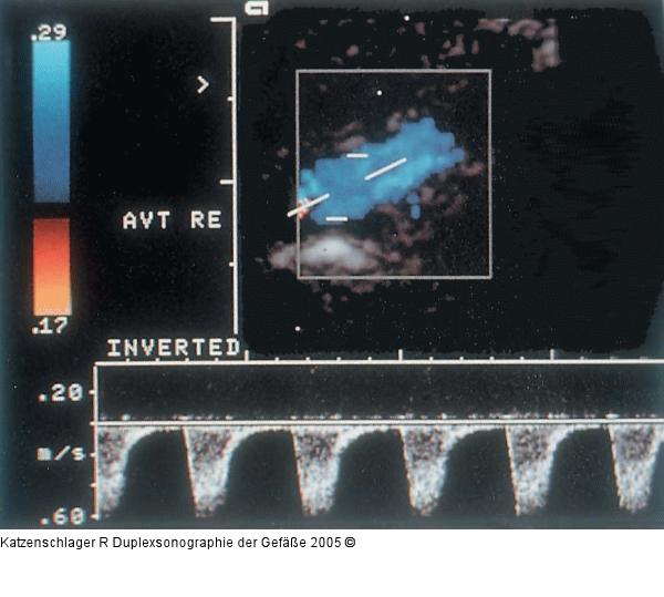 Duplexsonographie - Fluß retrograd