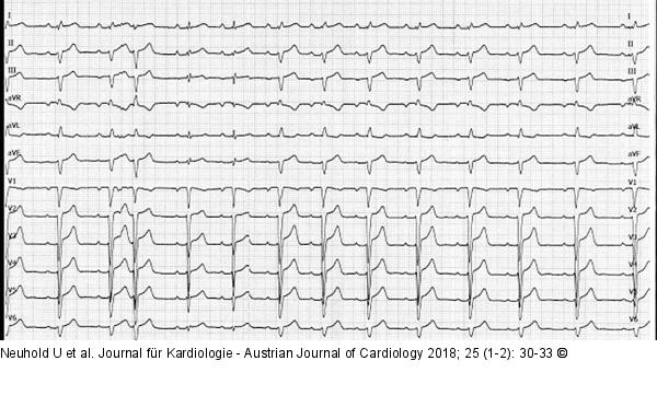 EKG