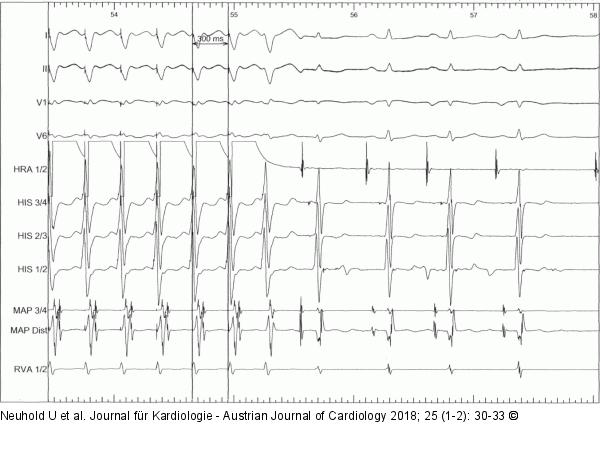 EKG