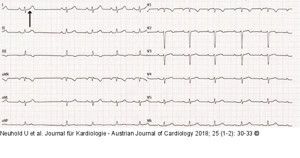 EKG