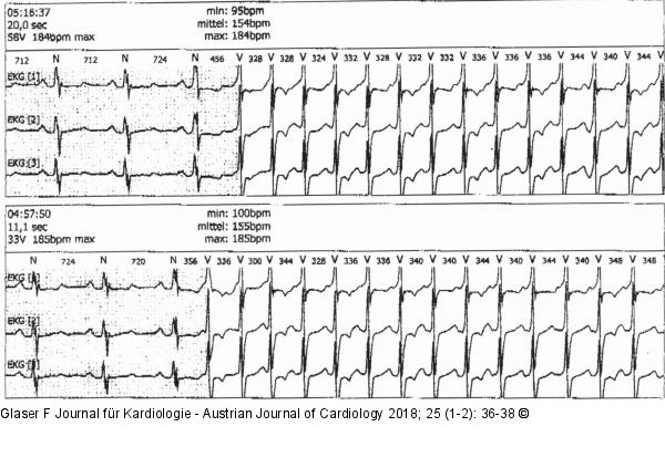 EKG