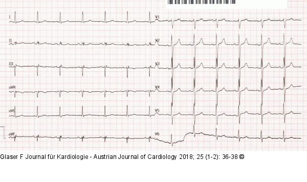 EKG