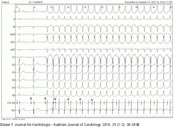 EKG