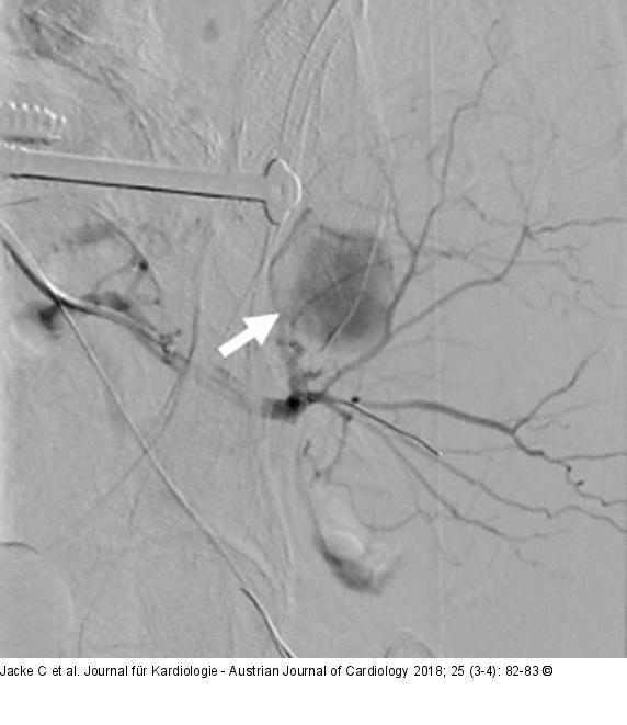 Blutungsspeisende Arterie