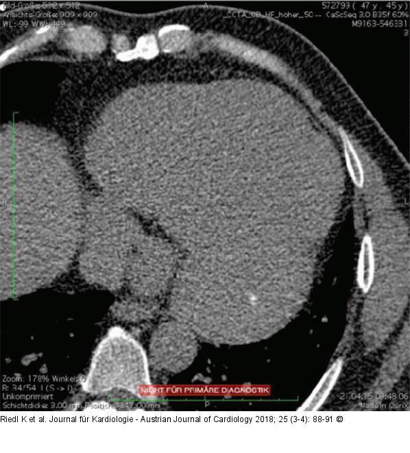 CT-Thorax