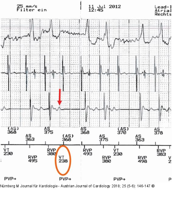 Intrakardiales EKG
