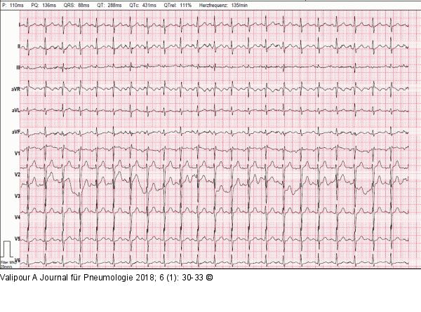 EKG
