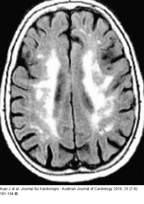 White Matter Läsionen