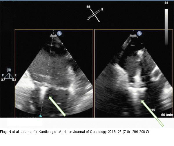 MitraClip®-Implantation