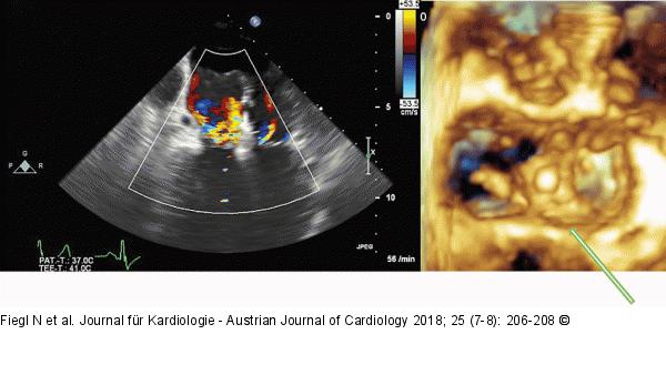 MitraClip®-Implantation