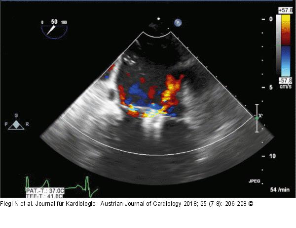 MitraClip®-Implantation