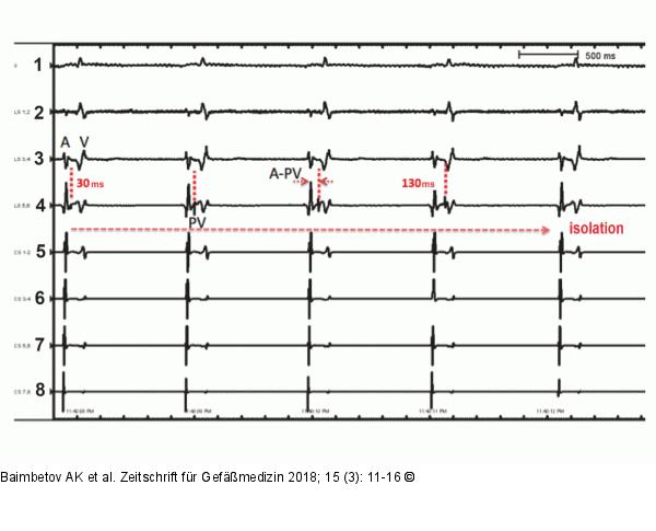 ECG and endograms