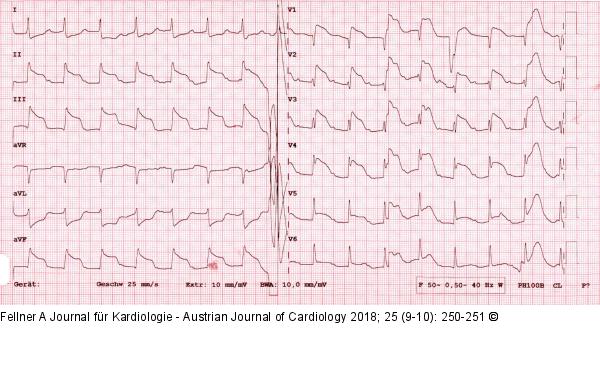 EKG