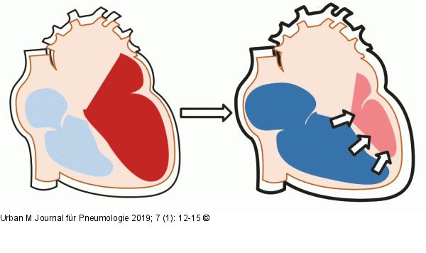 COPD