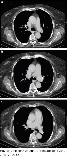 Thorax-CT