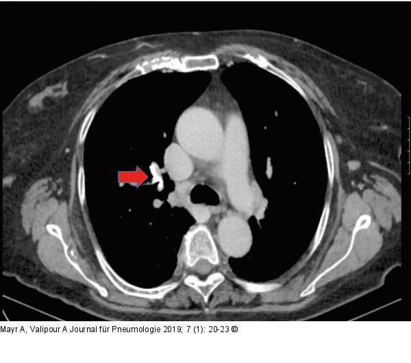 Thorax-CT