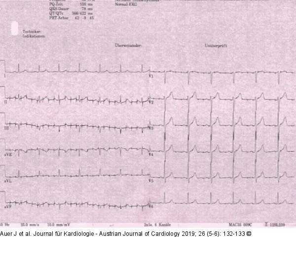 EKG