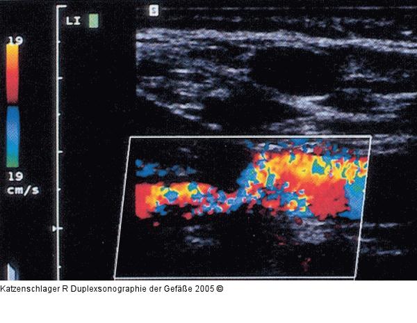 Duplexsonographie - A. subclavia