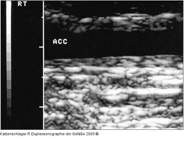 Duplexsonographie - Intima-Media - Karotis