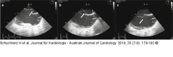 Vorhofseptumaneurysma