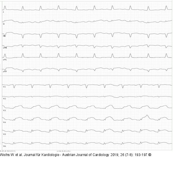 EKG