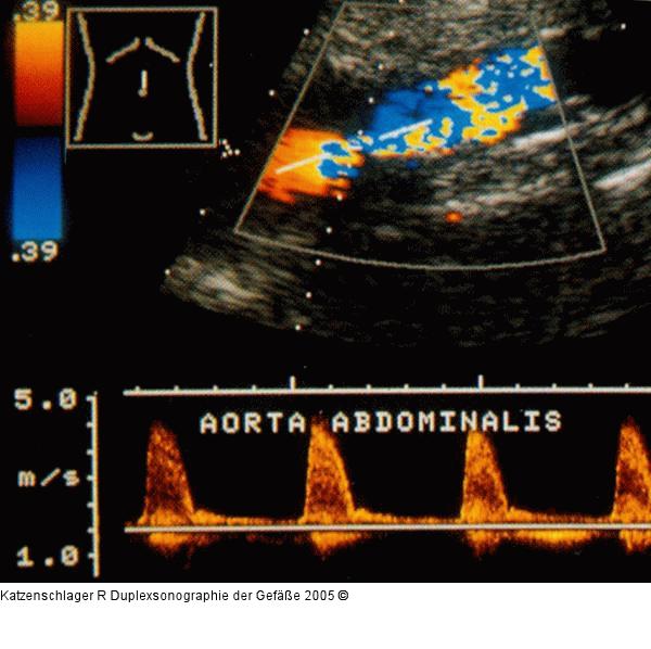 Duplexsonographie - A. abdominalis - Stenose