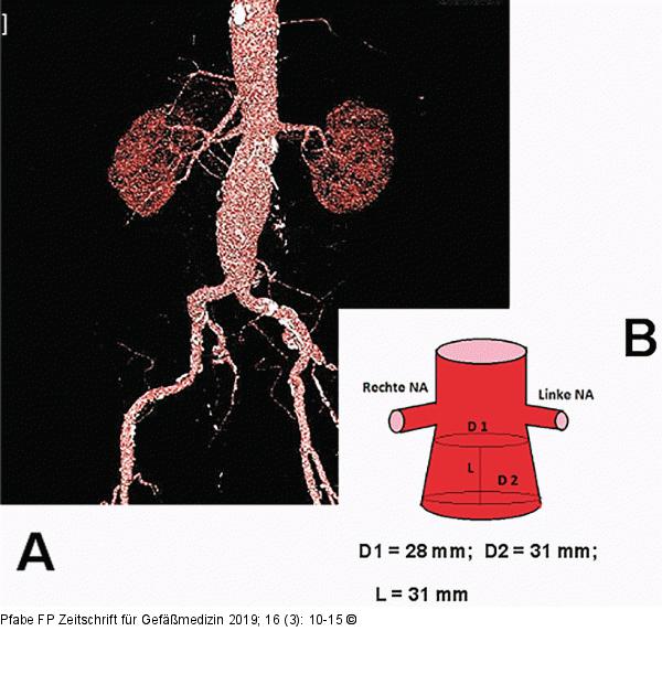 Aortenaneurysma