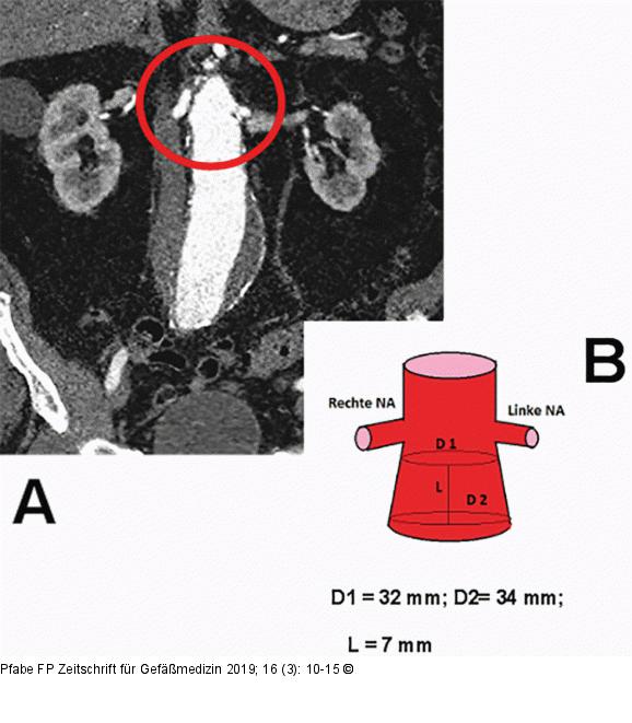 Infrarenales Aortenaneurysma