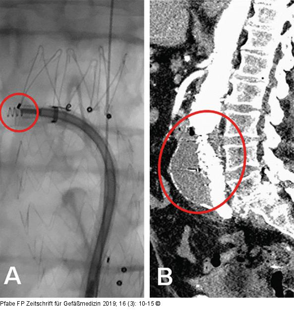 EndoAnchor-Implantation