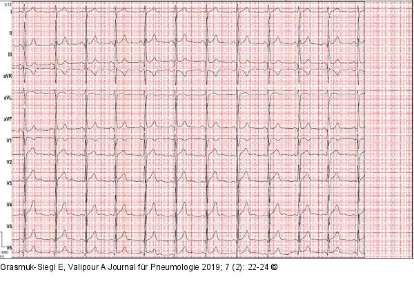 EKG