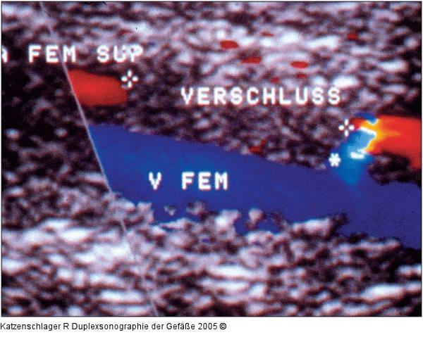Duplexsonographie - A. femoralis - Stenose