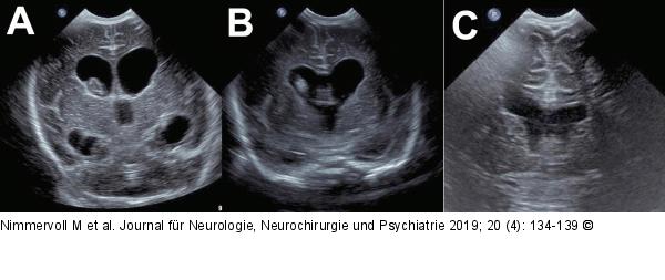 Zerebrale Sonografie