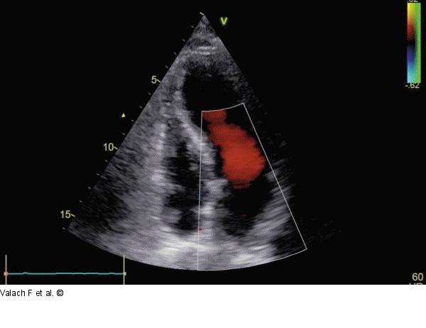 Thrombus
