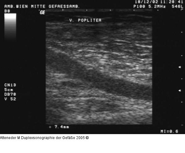 Duplexsonographie - V. poplitea